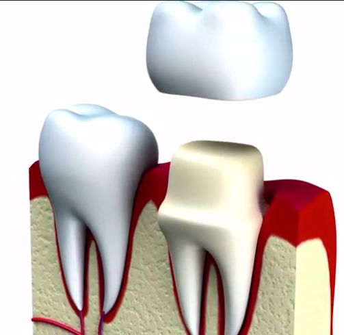 detecting-tooth-decay-under-crowns